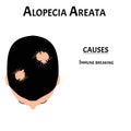 Alopecia hair. Baldness of hair on the head. Alopecia areata causes. Infographics. Vector illustration on isolated