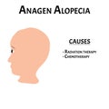 Alopecia hair. Baldness of hair on the head. Anagen Alopecia causes. Infographics. Vector illustration on isolated