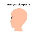 Alopecia hair. Baldness of hair on the head. Anagen Alopecia. Infographics. Vector illustration on isolated background.