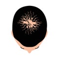 Alopecia hair. Baldness of hair on the head. Androgenic alopecia. Infographics. Vector illustration on isolated