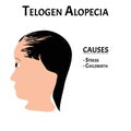 Alopecia hair. Baldness of hair on the head. Telogen Alopecia causes. Infographics. Vector illustration on isolated