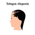 Alopecia hair. Baldness of hair on the head. Telogen Alopecia. Infographics. Vector illustration on isolated background.