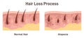 Alopecia. Hair loss, balding process. Cross-section anatomical structure