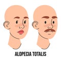 Alopecia totalis vector isolated. Two characters