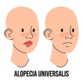 Alopecia universalis vector isolated. Two characters