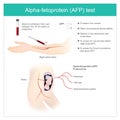 Alpha-fetoprotein AFP test. Use Analysis by AFP level. to dete