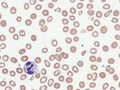 Alpha-thalassemia in peripheral blood.