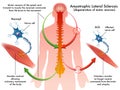 ALS (amyotrophic lateral sclerosis) Royalty Free Stock Photo