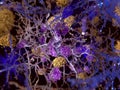 Alzheimer disease, neuron being phagocyted by microglia cells