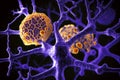 Alzheimer's and dementia disease: amyloid plaques forming between neurons. 3D illustration showing amyloid plaques