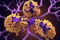 Alzheimer's and dementia disease: amyloid plaques forming between neurons. 3D illustration showing amyloid plaques