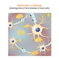 Alzheimer`s disease. dementia. Vector Background with neurons and amyloid plaques