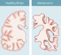 Alzheimer`s Disease