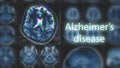 Alzheimer`s disease or Parkinson concept. Blurred MRI scan of brain with glitch effect