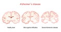 Alzheimer`s, is a neurodegenerative disease. dementia