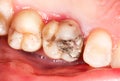 Amalgam filling