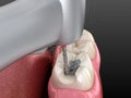 Amalgam removing and preparation for ceramic crown placement. 3D illustration of dental concept