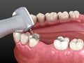 Amalgam removing and preparation for ceramic crown placement. 3D illustration of dental concept