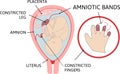 Amniotic bands. fetus is entangled in fibrous string-like amniotic bands in the womb Royalty Free Stock Photo