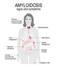 Amyloidosis. Signs and symptoms.