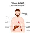 Symptoms of Amyloidosis