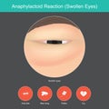 Anaphylactoid Reaction. Illustration show close up.