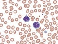 Anaplastic large-cell lymphoma. Peripheral blood.