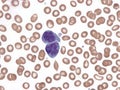 Anaplastic large-cell lymphoma. Peripheral blood.