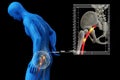 Pinched human sciatic nerve, anatomical vision. 3d illustration