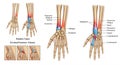 Anatomical illustration displaying different types of forearm fractures on skeletal Royalty Free Stock Photo