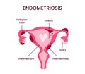 Anatomical illustration of the female reproductive system with the symptoms of endometriosis. Medical diagram with