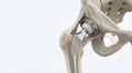 Detailed anatomical illustration of a hip joint prosthesis, showcasing the intricate design and materials used in modern Royalty Free Stock Photo