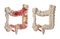 Anatomical model of large intestine on white background, collage. Gastroenterology