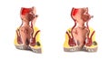 Anatomical model of rectum with hemorrhoids on white background, collage