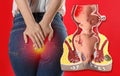 Anatomical model of rectum with hemorrhoids and woman suffering from pain on red background, closeup Royalty Free Stock Photo