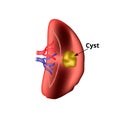 Anatomical structure of the spleen. Spleen cyst. Vector illustration on isolated background