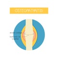 Vector illustration of a bone with osteoarthritis Royalty Free Stock Photo