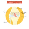 Vector illustration of meniscal tear of knee joint