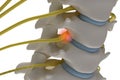 Anatomically accurate3d image of cervical spine with prolapse of
