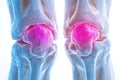 An anatomically correct illustration of an arthritic knee joint, featuring the human leg and knee meniscus Royalty Free Stock Photo