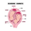 Anatomy of abdomen with twins. pregnancy type infographic elements in flat design.