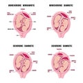 Anatomy of abdomen with twins. pregnancy types infographic elements in flat design.