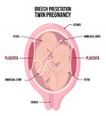 Anatomy of abdomen with twins. Pregnancy women diagrams with breech presentation for both children.