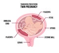 Anatomy of abdomen with twins. Pregnancy women diagrams