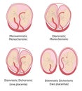 Anatomy of abdomen with twins. Twin types infographic elements in flat design Royalty Free Stock Photo