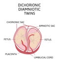 Anatomy of abdomen with twins. Twin types infographic elements in flat design. Monozygotic or Dizygotic Placentation of twins Royalty Free Stock Photo