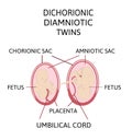 Anatomy of abdomen with twins. Twin types infographic elements in flat design. Monozygotic or Dizygotic Placentation of twins Royalty Free Stock Photo