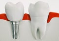 Anatomy of healthy teeth and dental implant in jaw bone - 3d rendering