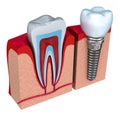 Anatomy of healthy teeth and dental implant in jaw bone.