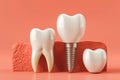 Anatomy of healthy teeth and tooth dental implant. ai generative Royalty Free Stock Photo